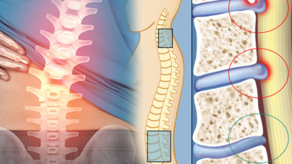 Ce este îngustarea măduvei spinării? Care sunt simptomele îngustării măduvei spinării? Există un remediu pentru îngustarea măduvei spinării?