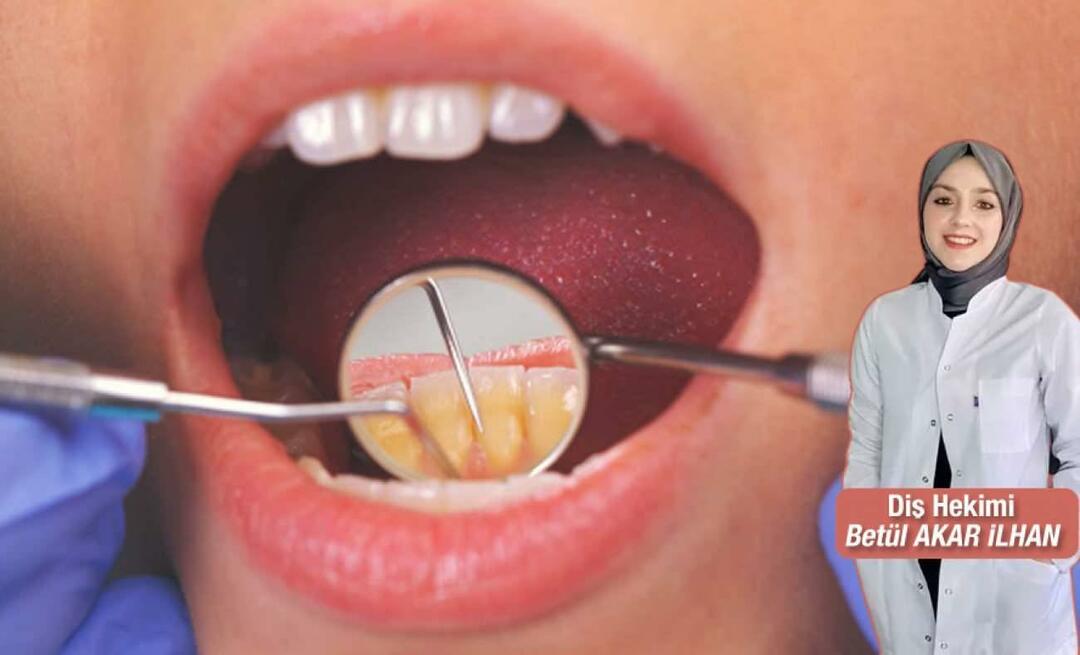 Ce ar trebui făcut pentru a evita tartrul? Care sunt beneficiile detartrajului dentar?