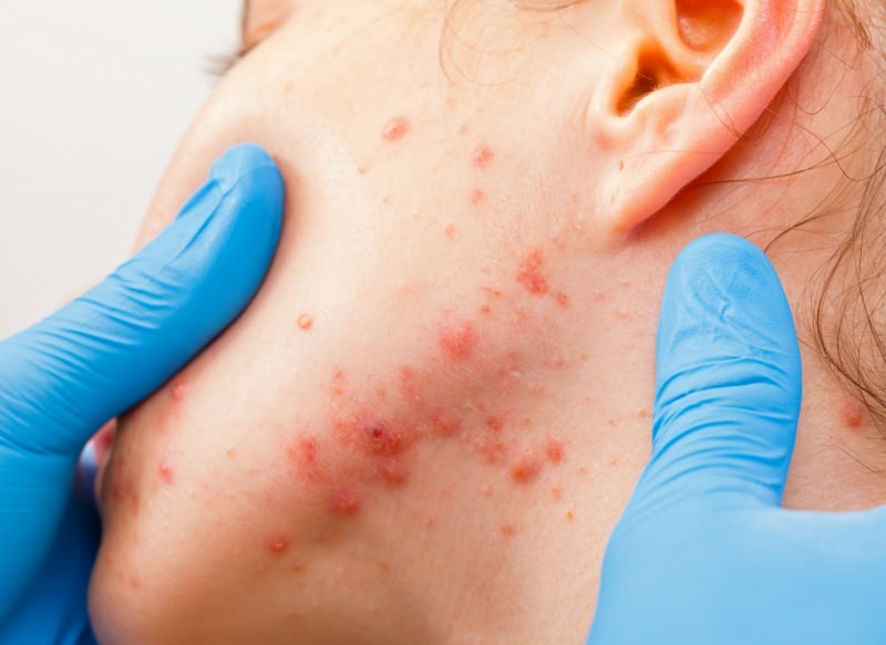 virusul provoacă vezicule pe suprafața pielii