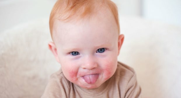 Atenție la bebelușii cu obraji roșii! Sindromul obrazului înfipt și simptomele acestuia