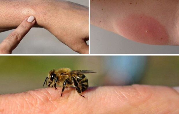 simptomele alergiei la albine