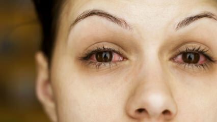 Ce este conjunctivita (gripa ochilor) și care sunt simptomele? Cum se transmite conjunctivita?