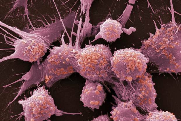 Ce este cancerul și care sunt simptomele acestuia? Câte tipuri de cancer există? Cum se previne cancerul?